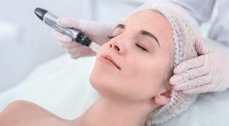 MICRONEEDLING (NEOPEN)